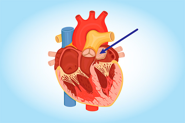 cardiac myxoma heart tumor diagram
