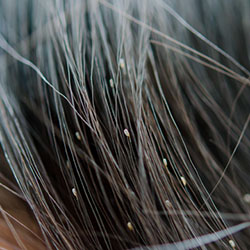 Close up of head hair with lice in it
