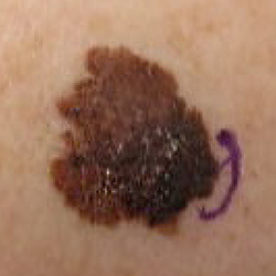 skin cancer with uneven border