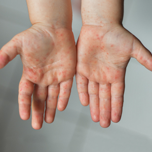 two open hands showing the palms of a person with hand foot mouth disease