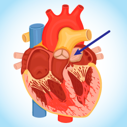cardiac myxoma heart tumor diagram
