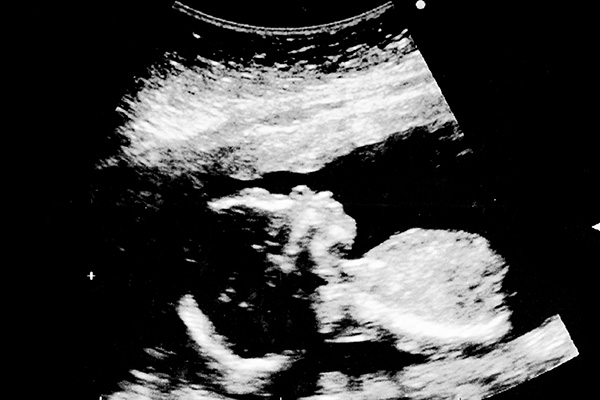 fetus in ultrasound image